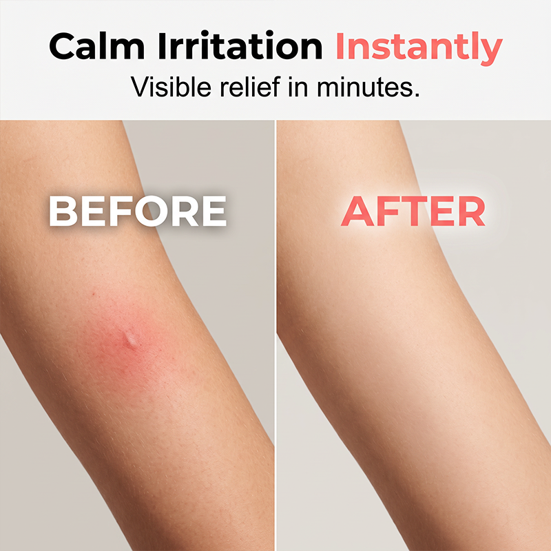 ✨ Portable Bug Bite Itch Relief Heat Pen | Chemical Free Insect Sting Soothing Device